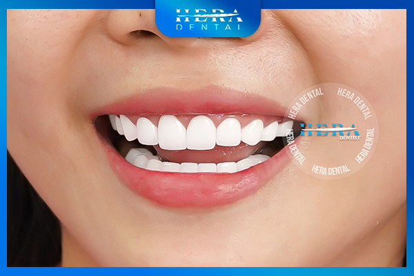 Khách hàng sau khi bọc sứ tại Hera Dental (Ảnh 2)