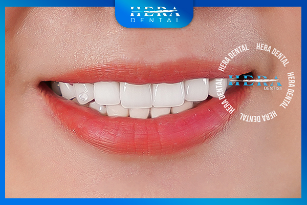 Khách hàng sau khi bọc sứ tại Hera Dental (Ảnh 4)