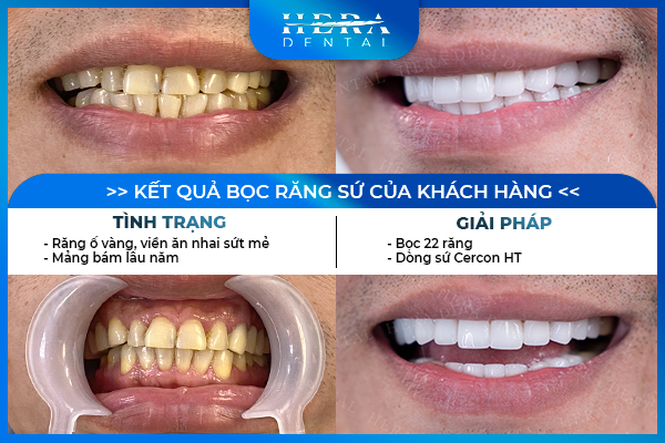 Kết quả bọc răng sứ thực tế cho khách hàng tại Hera